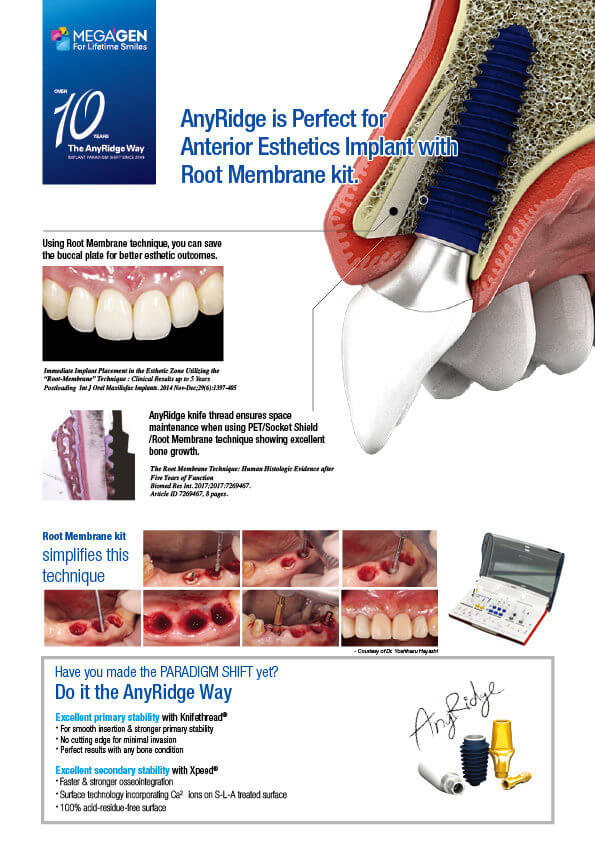 AnyRidge is Perfect for Anterior Esthetics Implant with Root Membrane kit.