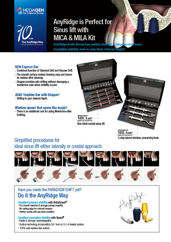 AnyRidge is Perfect for Sinus lift with MICA & MILA kit