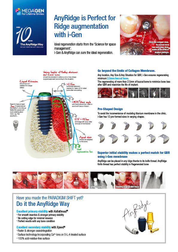 AnyRidge is Perfect for Ridge augmentation with i-Gen