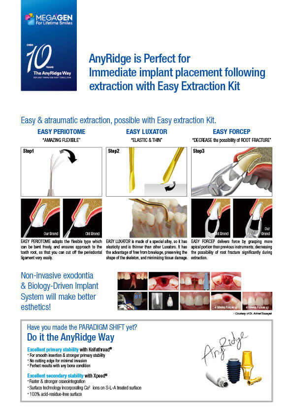 AnyRidge is Perfect for Immediate implant placement following extraction with Easy Extraction Kit