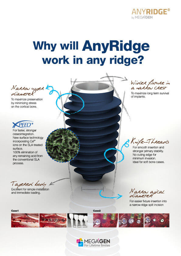 Why will AnyRidge work in any ridge?